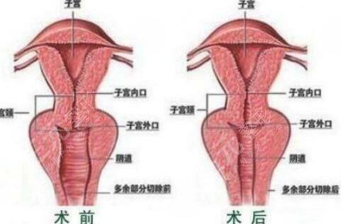 李薇 私密整形會不會有后遺癥
