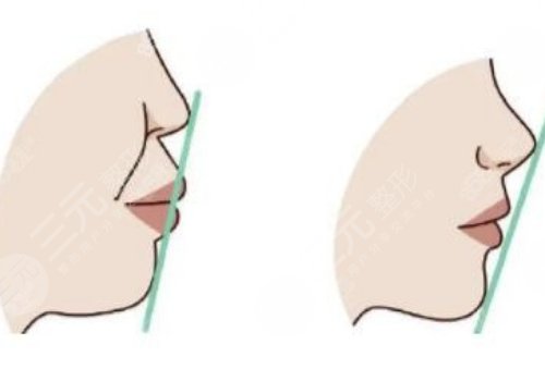 下巴后縮嘴凸怎么改良