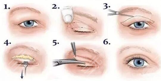 陸軍總醫(yī)院整形美容科雙眼皮整形案例