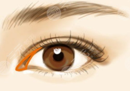 雙眼皮分為哪幾種做法？