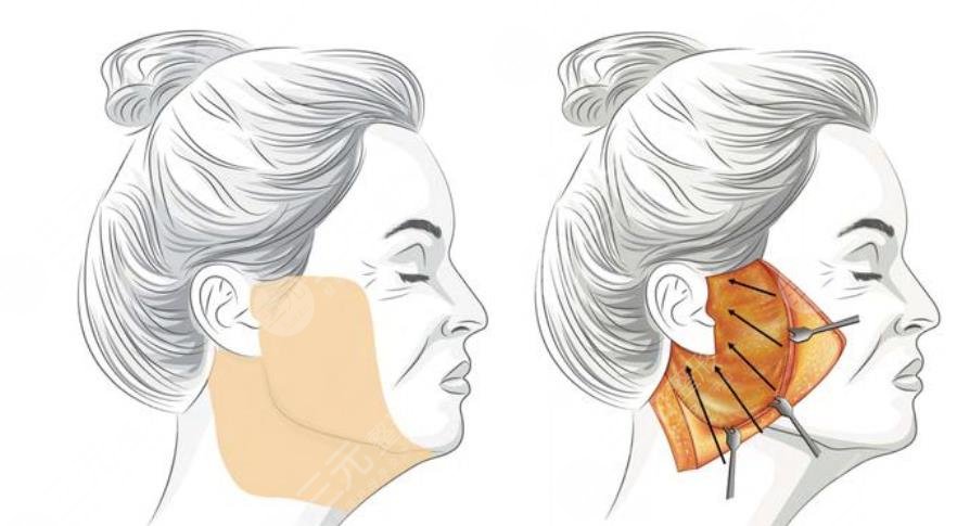 上海華山醫(yī)院拉皮手術(shù)案例