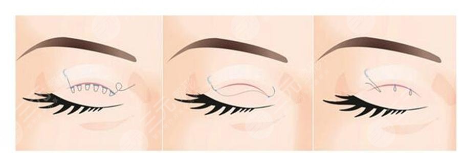 雙眼皮分為哪幾種做法？