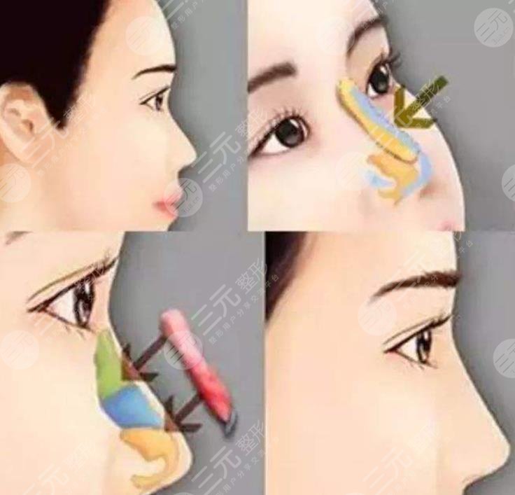 上海九院隆鼻案例