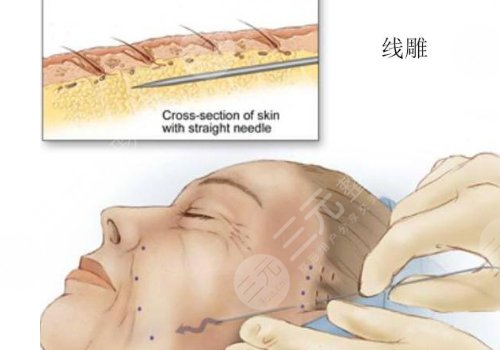 韓國(guó)美迪塑線雕怎么樣