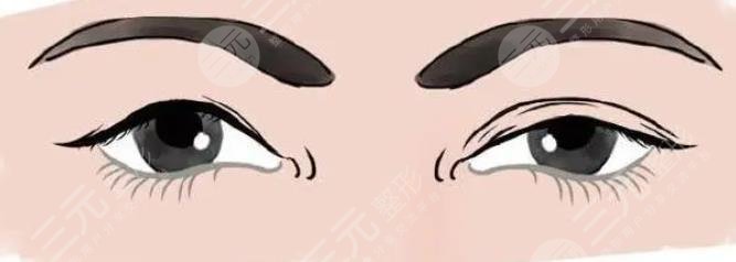 修復(fù)雙眼皮