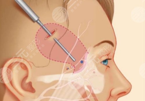 微拉美的危害和副作用都有哪些？