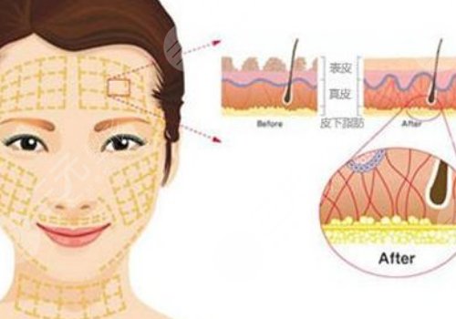 韓國美迪塑線雕能維持幾年
