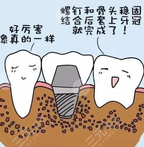 上海長海醫(yī)院口腔科牙齒種植案例