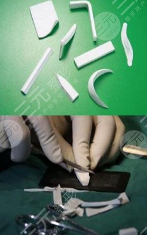 上海同濟(jì)醫(yī)院整形外科假體隆鼻案例