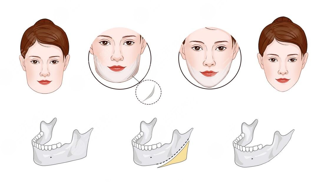 上海時(shí)光做顴骨多少錢