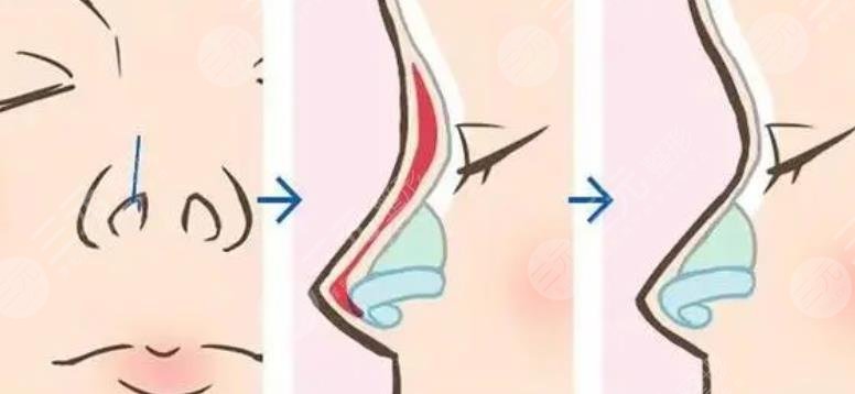 上海華山醫(yī)院假體隆鼻案例