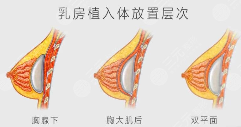 假體隆胸術后可以哺乳嗎?