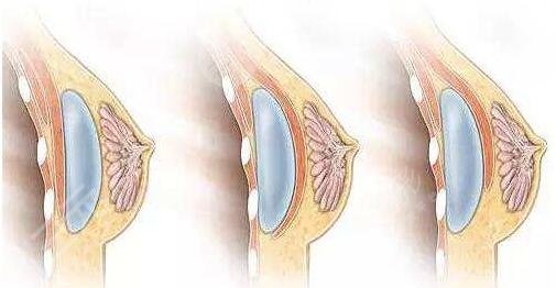 假體隆胸術后可以哺乳嗎?