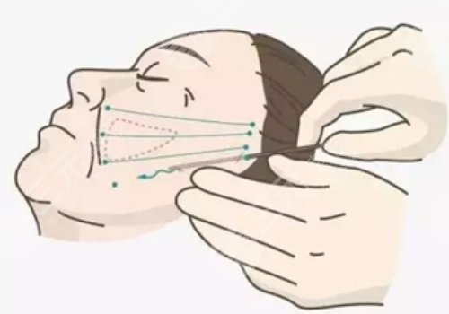 筋膜提升術(shù)多少錢？