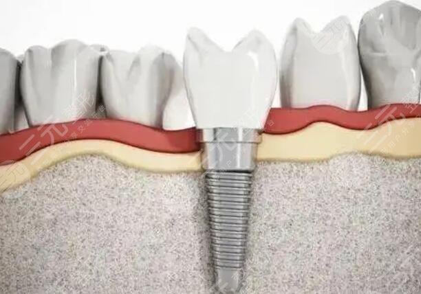 仕諾康SNUC種植牙