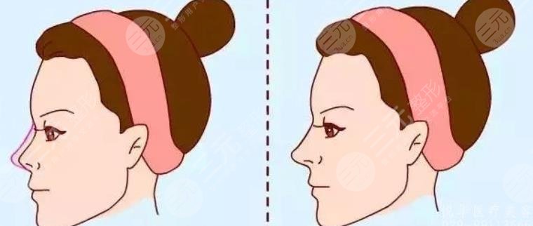 上海東方醫(yī)院隆鼻怎么樣