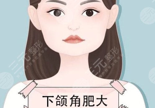 下顎整容手術一般要多少錢