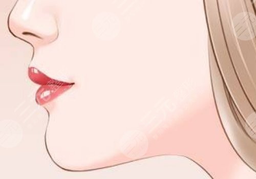 下顎整容手術一般要多少錢