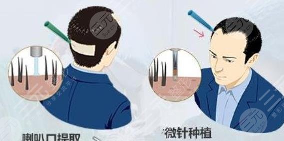 上海同濟醫(yī)院植發(fā)價格怎么樣