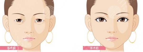 長(zhǎng)沙希美醫(yī)療美容怎么樣？?jī)晌会t(yī)生強(qiáng)項(xiàng)介紹，雙眼皮案例測(cè)評(píng)！