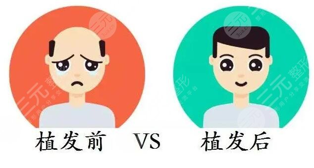 上海仁濟醫(yī)院植發(fā)中心發(fā)際線改良案例