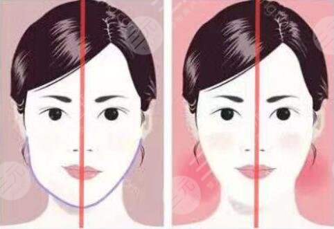 下頜骨一高一低臉歪怎么矯正？左右臉不對(duì)稱能矯正過來嗎？