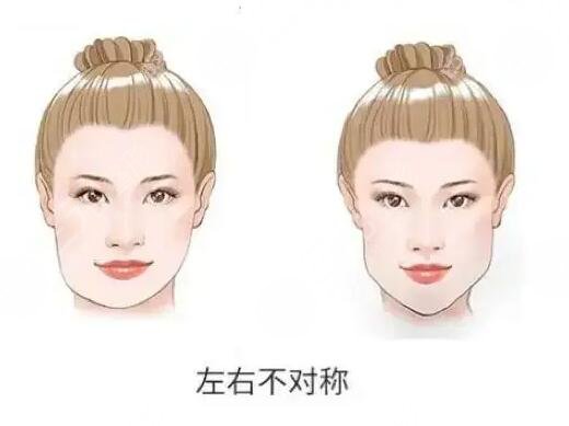 下頜骨一高一低臉歪怎么矯正？左右臉不對(duì)稱能矯正過來嗎？
