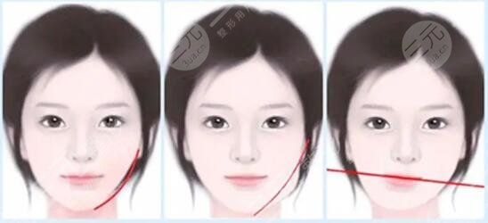 下頜骨一高一低臉歪矯正后需要怎樣護(hù)理?