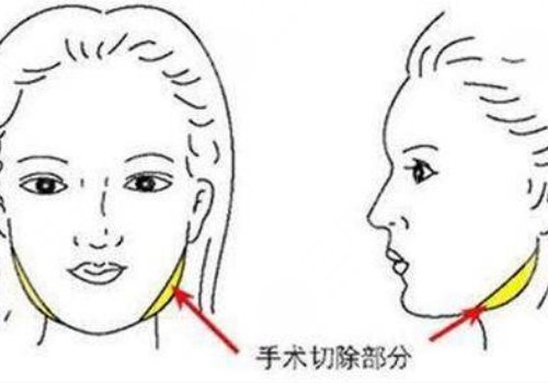 削骨三年后的真實案例