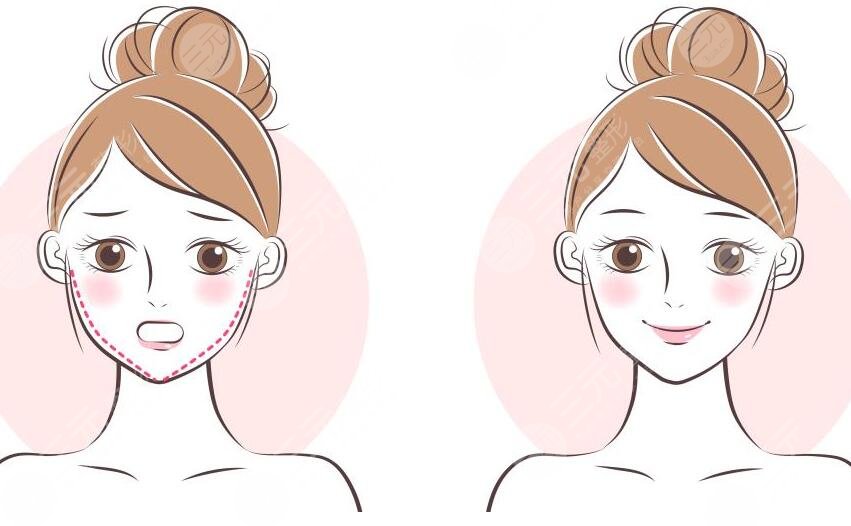 發(fā)腮臉變寬了還能變回去不？