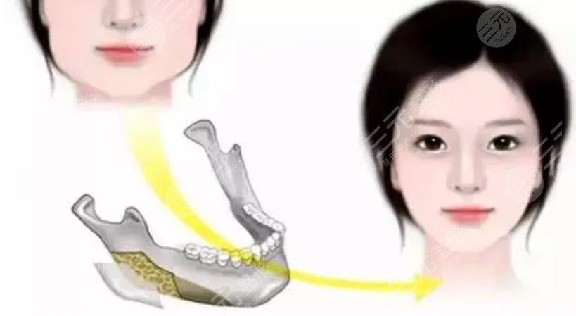 崔榮達(dá)醫(yī)生磨骨案例分享