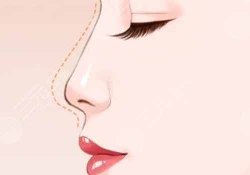 鐘青杰醫(yī)生做鼻子怎樣？