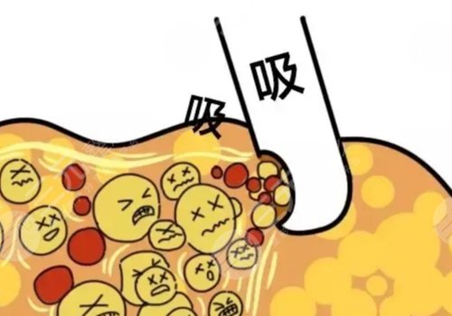 臀部脂肪怎么減？