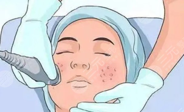 上海馬剛醫(yī)生激光祛斑案例