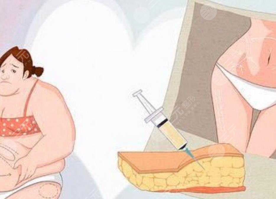 王榮錫醫(yī)生吸脂案例