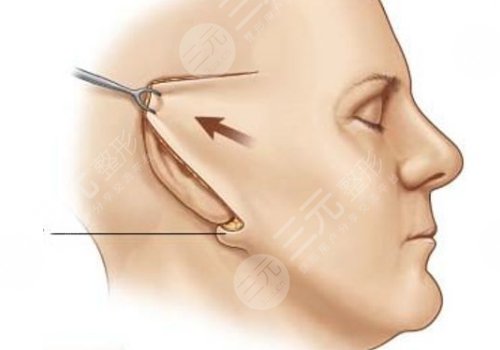 上海九院做臉部拉皮的專家