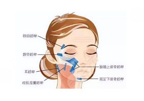 小切口拉皮手術(shù)費(fèi)多少錢