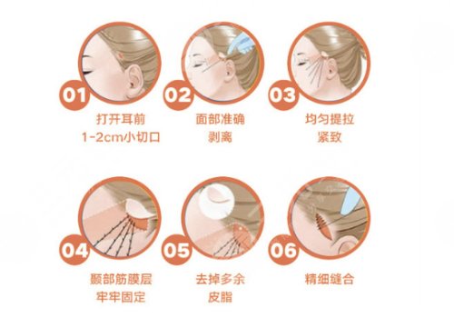 小切口拉皮手術(shù)費(fèi)多少錢