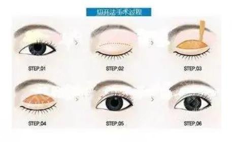 周珍艷醫(yī)生雙眼皮修復(fù)案例