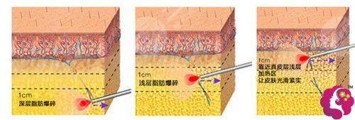 臀部脂肪怎么減？