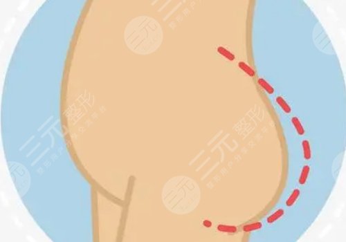 脂肪豐臀多久能恢復好？