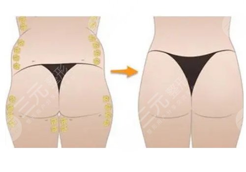 脂肪豐臀多久能恢復好？