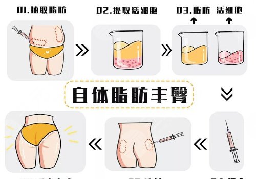 脂肪豐臀多久能恢復好