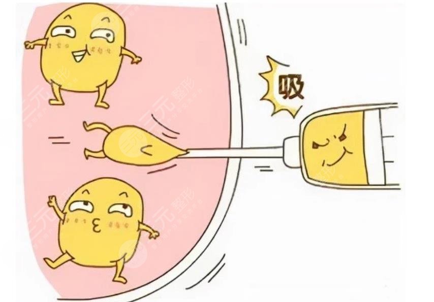 王榮錫醫(yī)生抽脂怎么樣