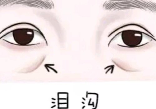 淚溝凹陷怎么解決好？