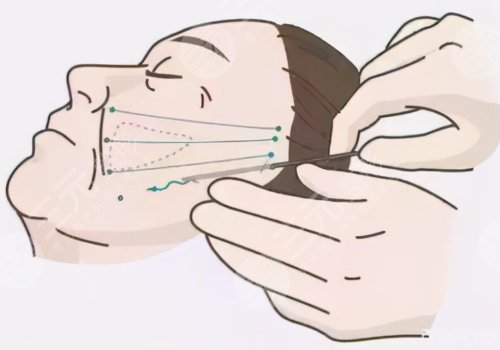 筋膜懸吊術可以維持幾年？