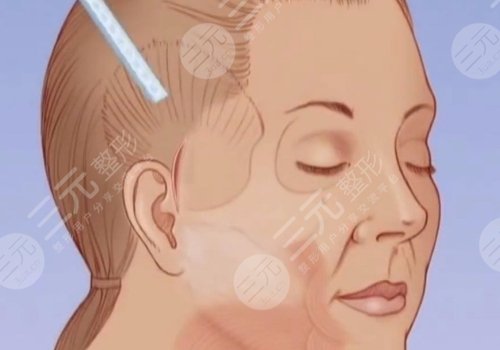 筋膜懸吊術可以維持幾年