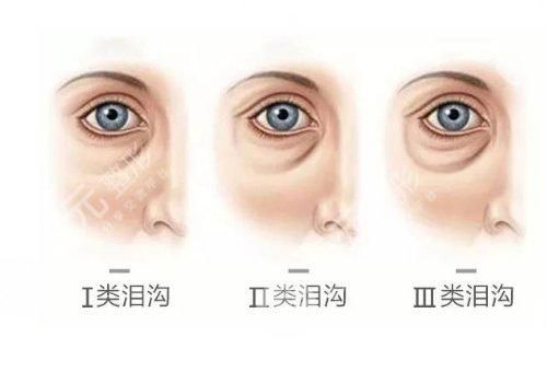 淚溝填充大概要多少錢？