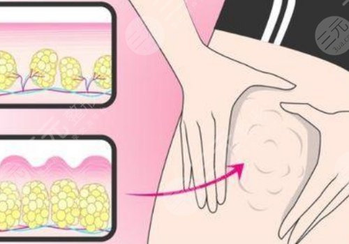 深圳美萊郭杰的抽脂真實水平怎么樣