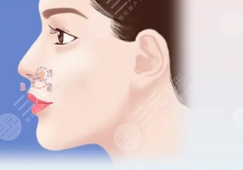 猴化臉鼻基底怎么解決